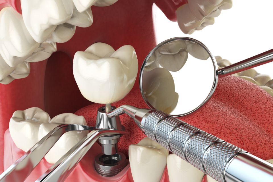 植牙過程要多久？植牙流程5步驟，一篇就懂植牙療程、原理、注意事項