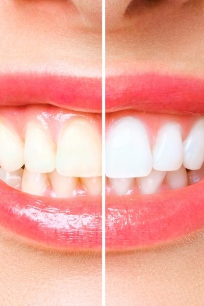 Teeth Whitening (3)_c