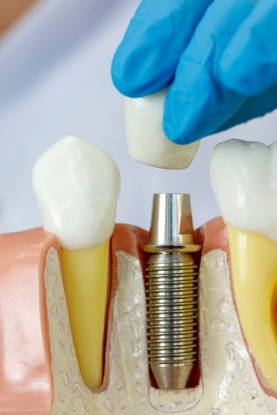 dental-implant01_c