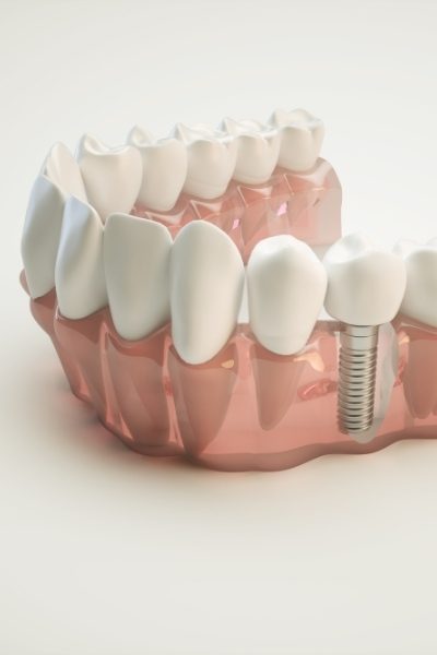 dental-implant02_c