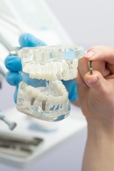dental-implant03_c