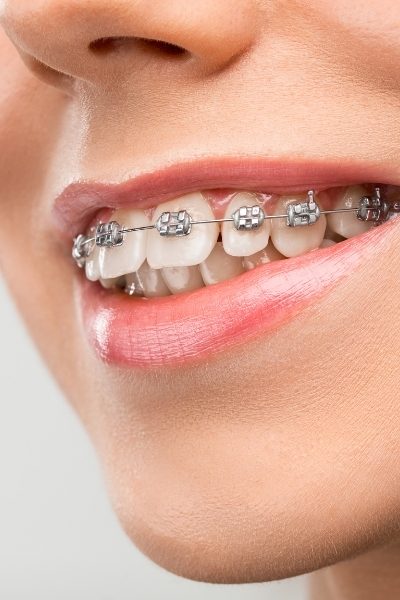 orthodontics (1)_c